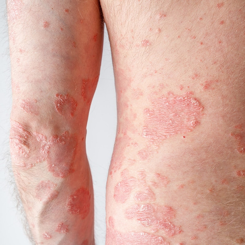 Skin Condition -Medical Dermatology