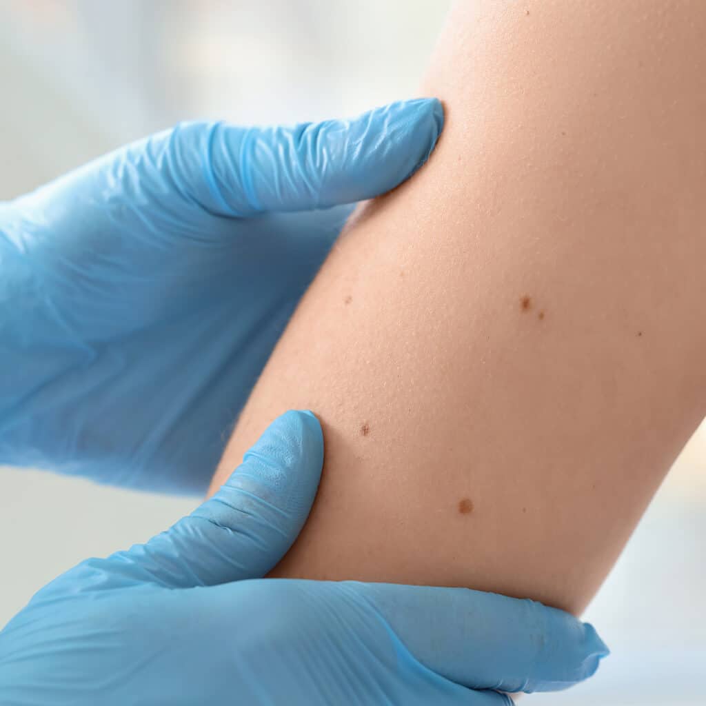 Skin examination, cancer screening