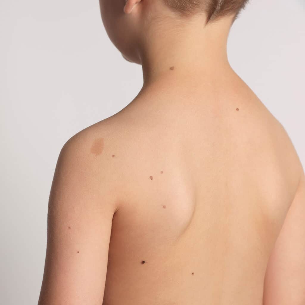 Pediatric Dermatology Services