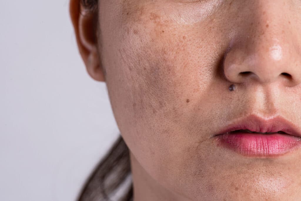 Skin Condition -Medical Dermatology